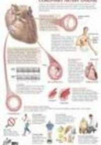 Coronary Artery Disease Chart - F. Netter